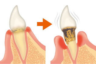 歯周病で骨が溶ける